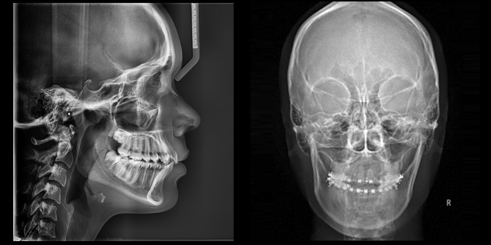 Radiografia de maxilar y mandibula