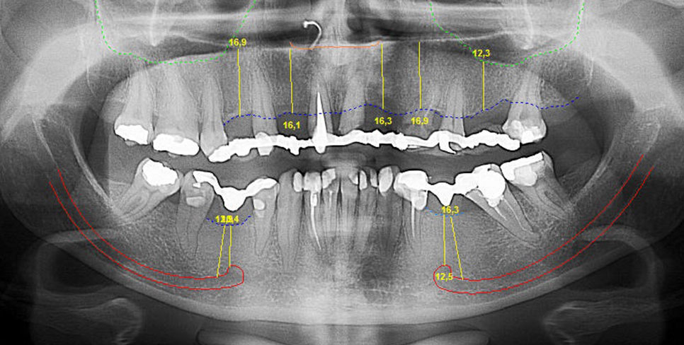 Radiografia Panorâmica de Mandíbu-la. Pós-Operatório de cinco meses.