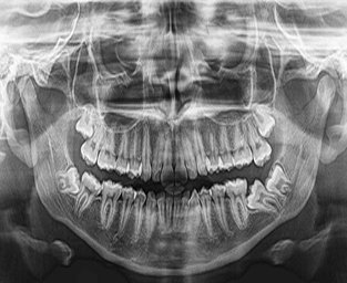 Radiografia Panorâmica da mandíbula não evidencia lesões sugestivas de